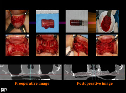 図3　インプラント治療の適応症拡大のための上顎洞底挙上術と腸骨移植術 