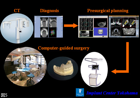 図5　ＣＴ診断、インプラント埋入シミュレーション、コンピュータ支援手術までの一連の流れ