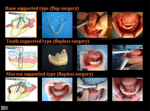 図6　各種サージガイドと手術方法。支持形式により骨面支持型・歯牙支持型・粘膜支持型の3種類に分類され、骨面支持型は切開剥離して使用し、歯牙支持型・粘膜支持型はフラップレスを基本にしている。